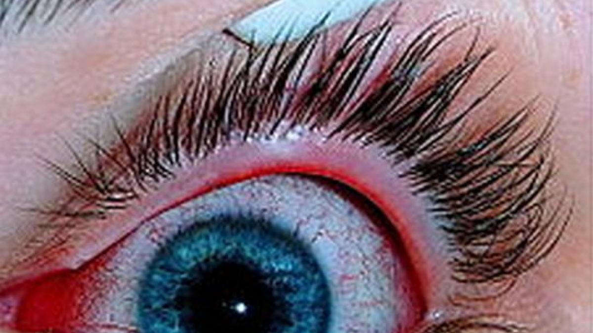 risc de epidemie de conjunctivita in capitala apa din piscina dar chiar si cea de la mare poate sa