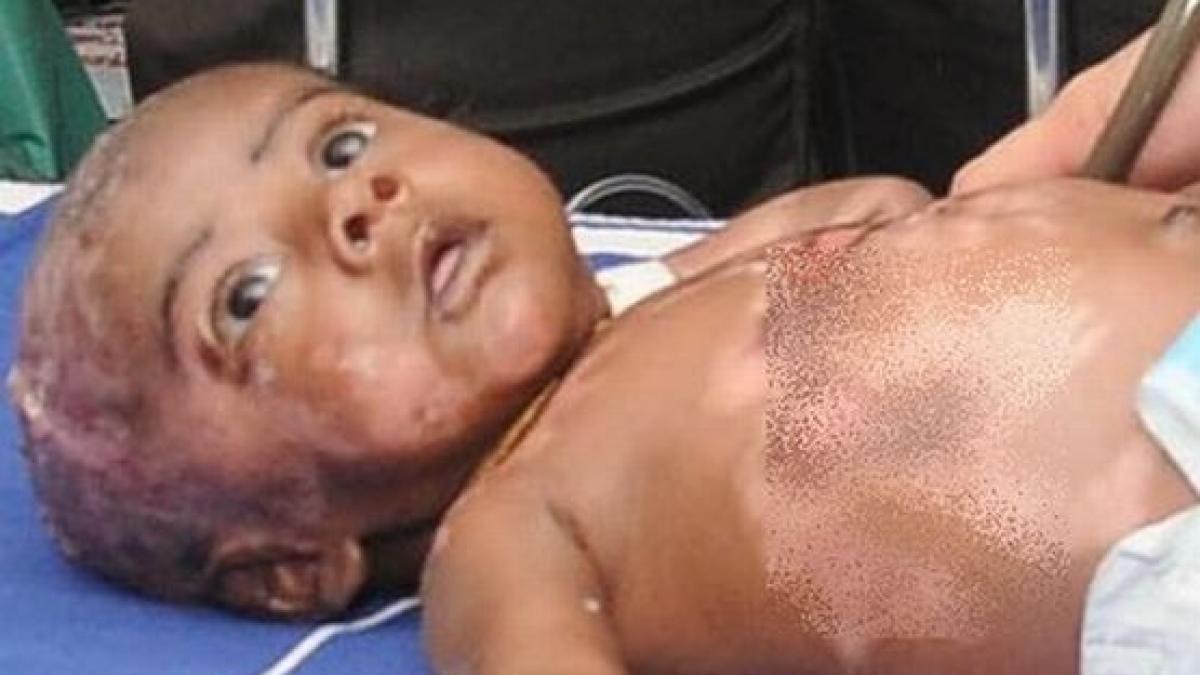 cazul care i a bulversat pe medicii din india acest bebelus se transforma intr o torta umana de
