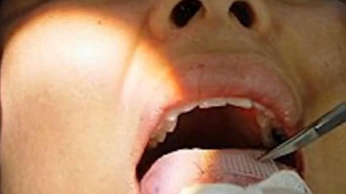 metoda extrema de slabit da rezultate rapide dar poate provoca dureri groaznice