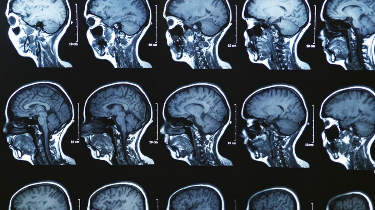 boala de care sufera milioane de romani poate afecta iremediabil creierul au descoperit asta acum