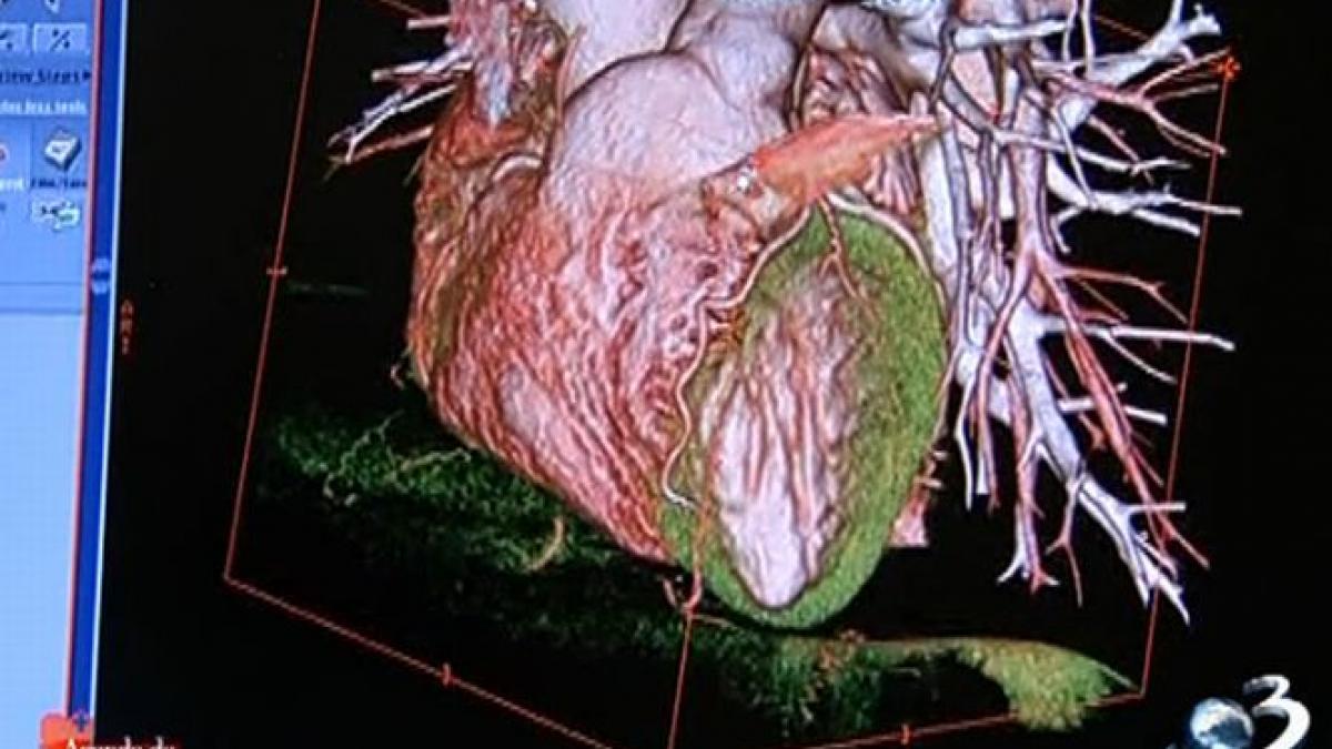 agenda de sanatate cardiopatia ischemica una dintre cele mai intalnite boli ale inimii