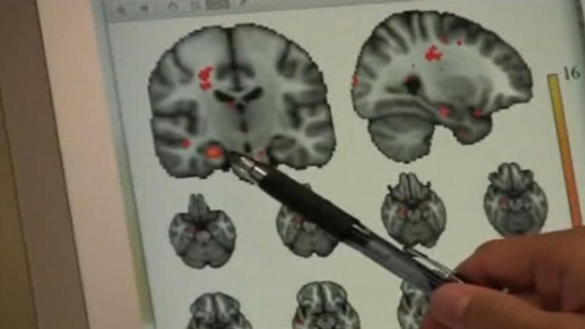 doi medici romani sustin ca activitatea creierului nu se opreste in moarte cerebrala