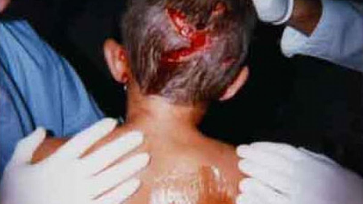 o fetita de 3 ani a fost desfigurata de un caine