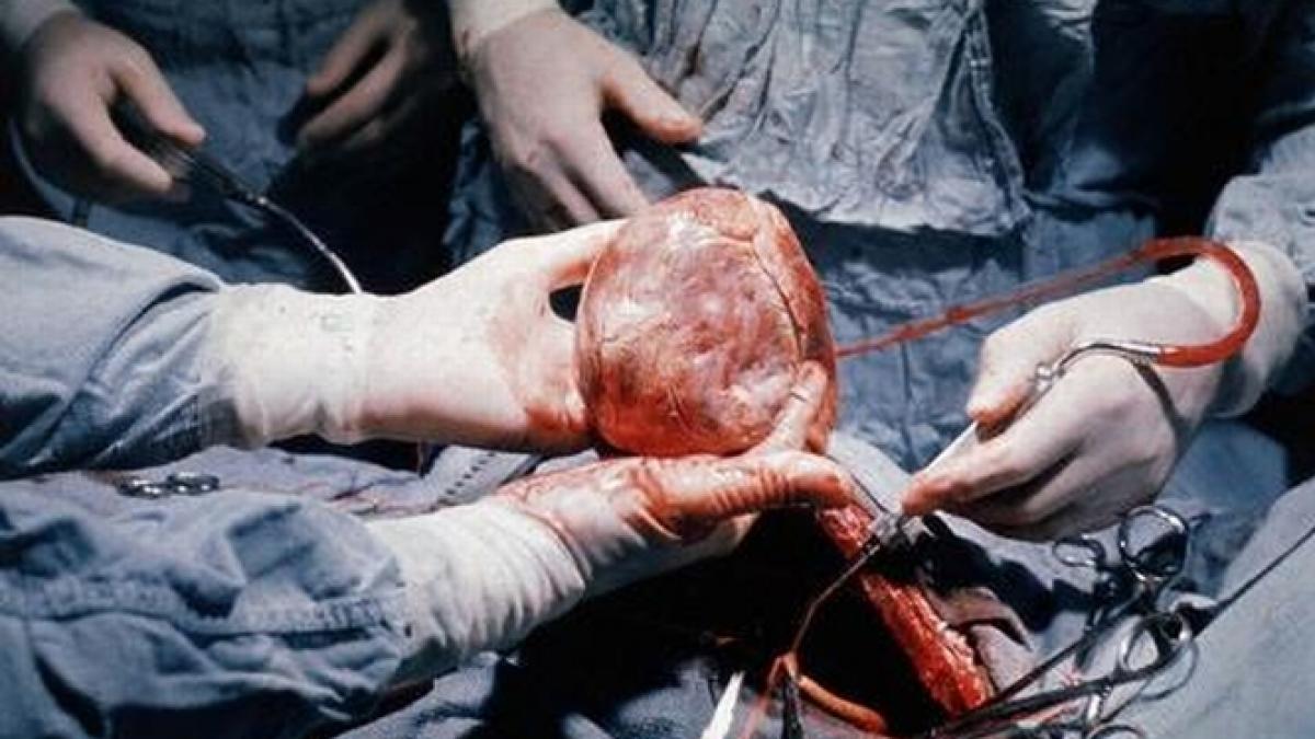 transplantul de cord va fi reluat la institutul de urgenta pentru boli cardiovasculare din targu