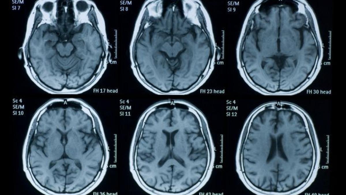 studiu marijuana poate afecta memoria si ar putea chiar avea legatura cu schizofrenia