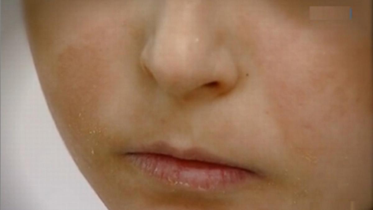 copilul de 12 ani salvat dupa ce a ars ca o torta are nevoie de noi operatii