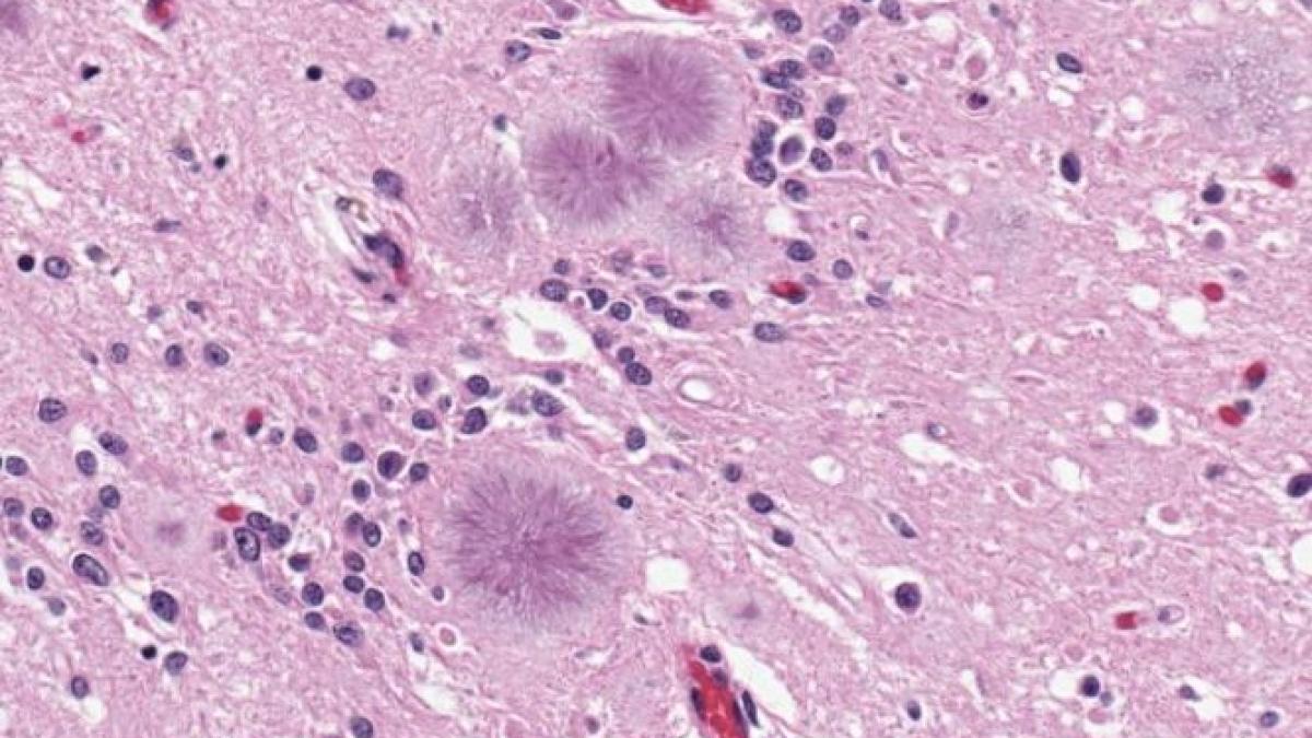 medicii unui spital din sua catre 18 pacienti este posibil sa fi fost expusi unei boli incurabile