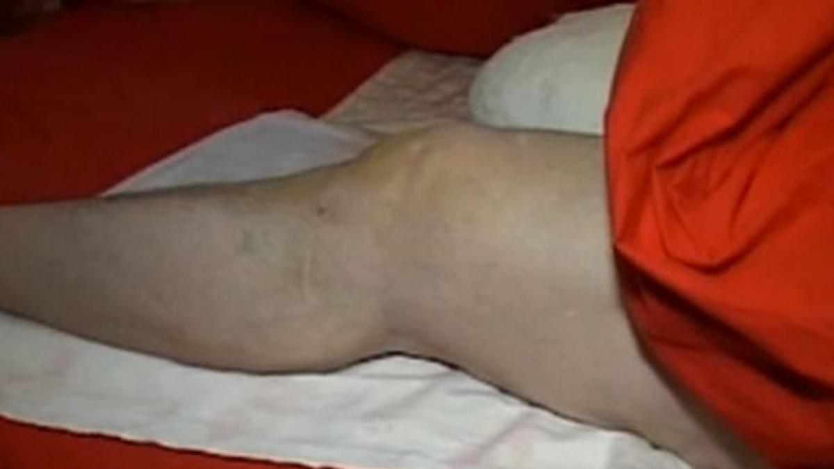 mi a amputat piciorul desi putea fi salvat acuzatii grave impotriva medicilor ortopezi din galati