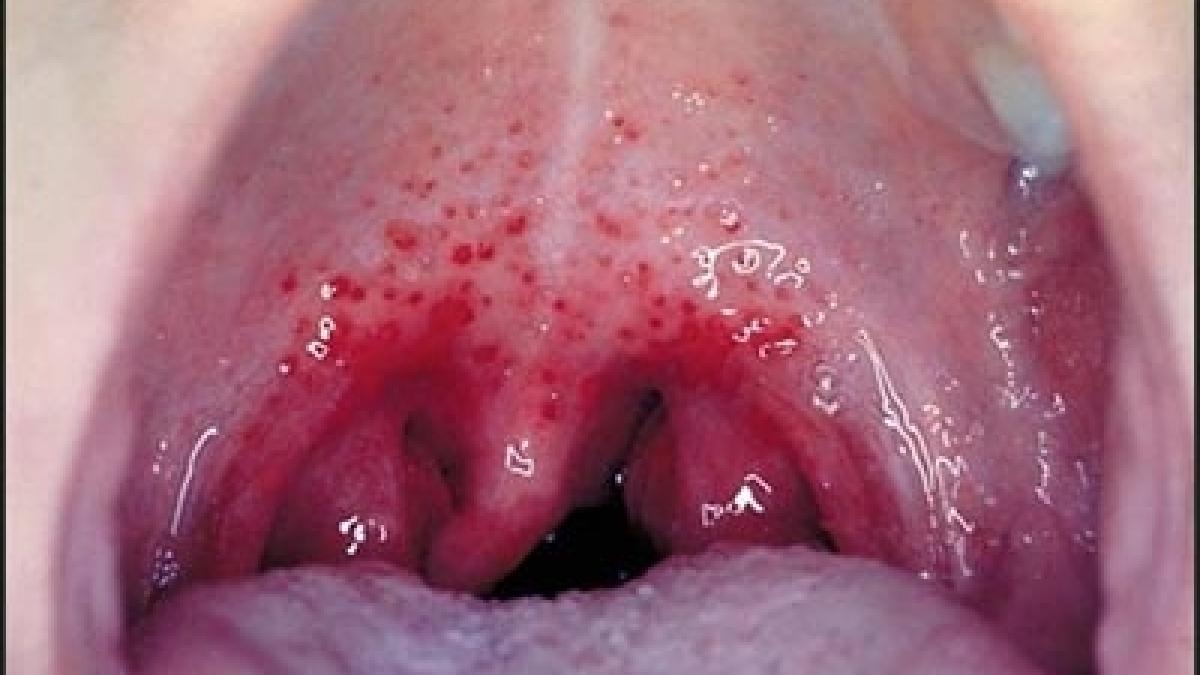 milioane de oameni in pericol o boala cu transmitere sexuala ar putea deveni incurabila nu mai