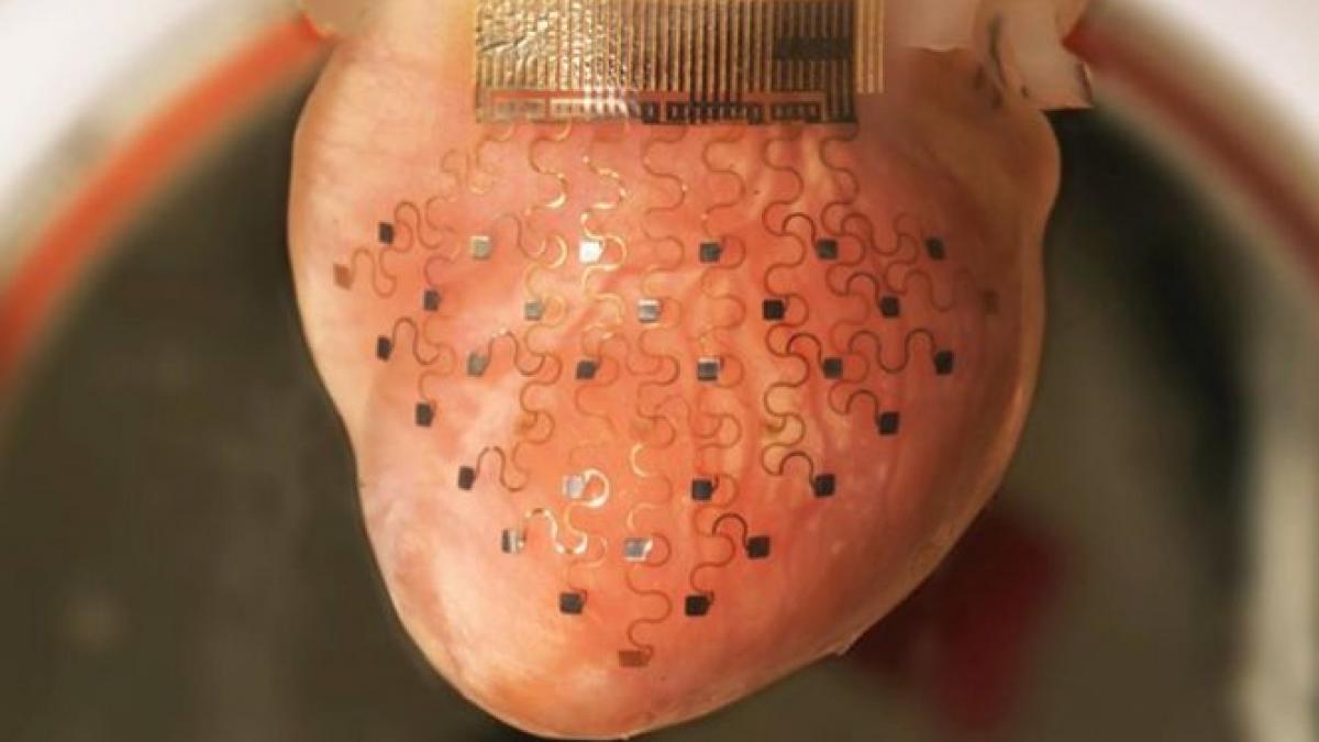 aparatul revolutionar care poate mentine ritmul cardiac membrana electrica ar putea inlocui