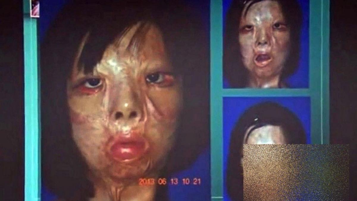 premiera istorica in lumea medicinei cum arata acum aceasta tanara dupa operatie