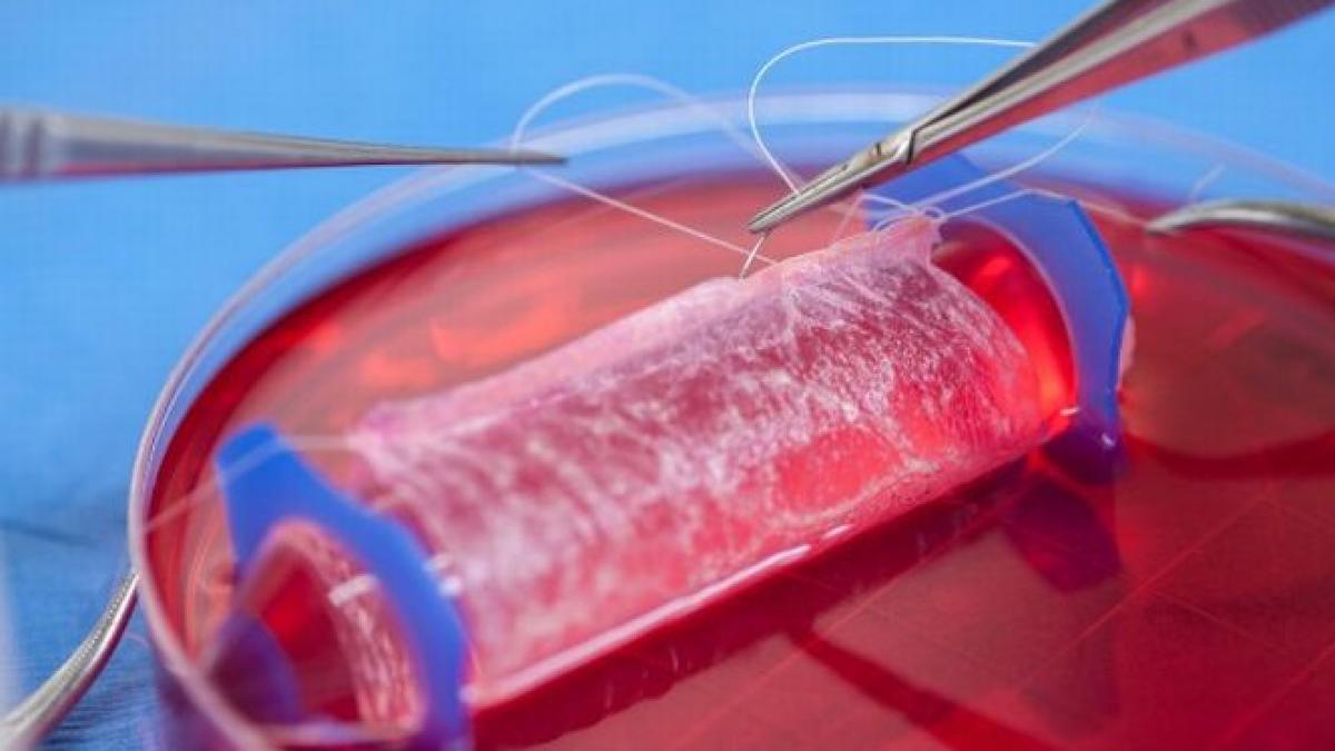 succes in medicina regenerativa sansa la o viata normala pentru patru tinere nascute fara vagin