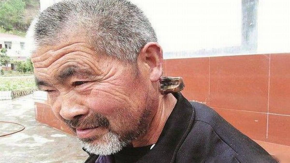 Un chinez suferă de o boală extrem de rară. Îi creşte un CORN din ceafă