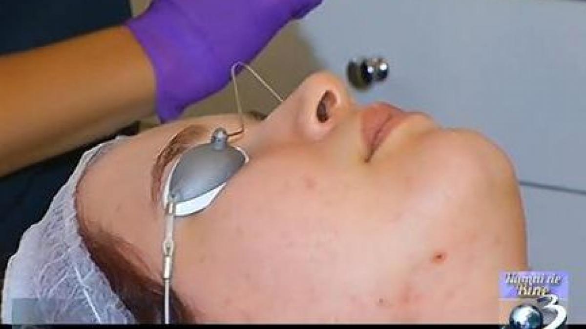 numai de bine acneea ce stim si ce se poate face