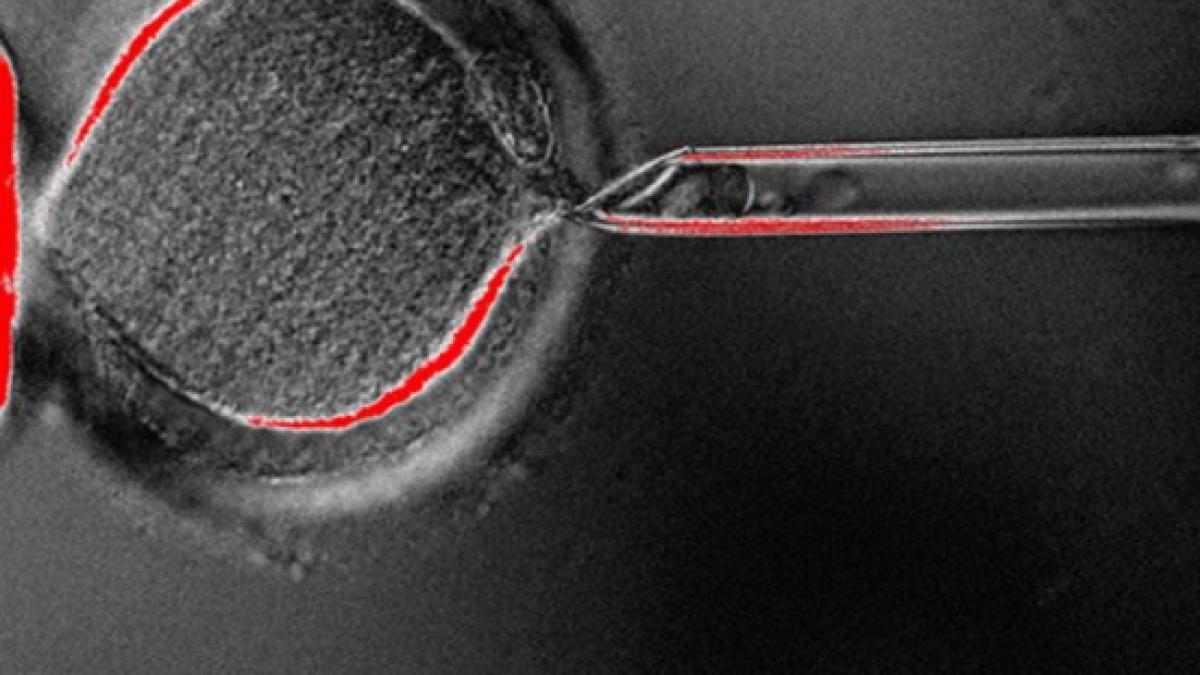 in premiera nationala trei copii cu paralizie cerebrala au fost tratati cu celule stem recoltate la