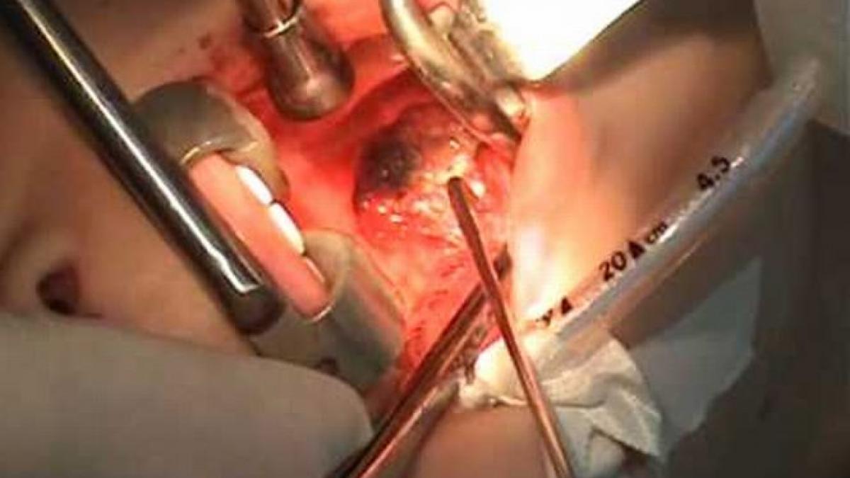 un copil de 2 ani din timisoara in coma dupa o banala operatie de amigdalita