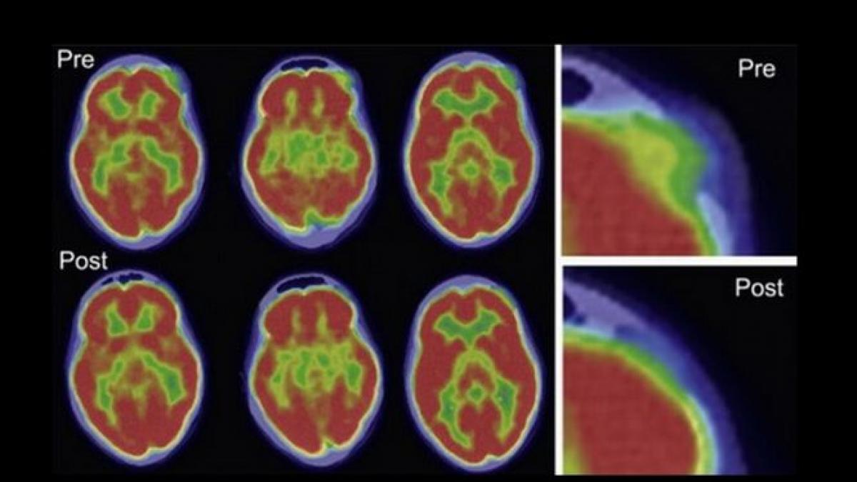 prima data in istorie oamenii de stiinta au vindecat un cancer cu ajutorul unui vaccin rujeolic