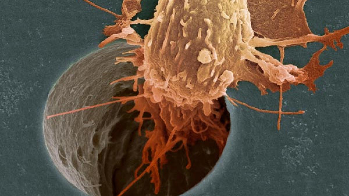 ultima descoperire a oamenilor de stiinta cancerul de prostata cauzat de o boala cu transmitere