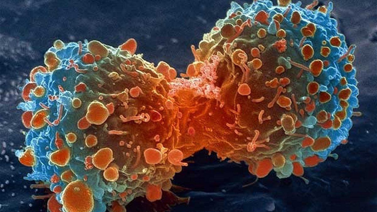 Cancerul - de ce se îmbolnăvesc oamenii de cancer ?