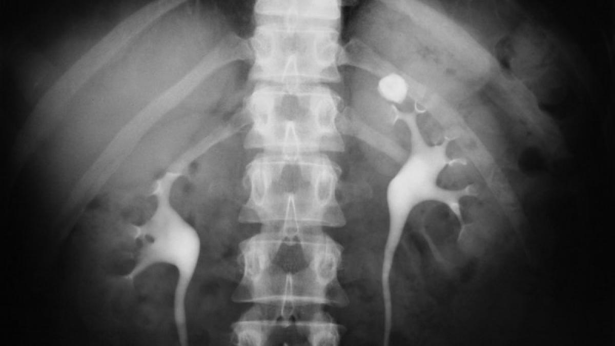 atentie la lichidele care favorizeaza aparitia pietrelor la rinichi