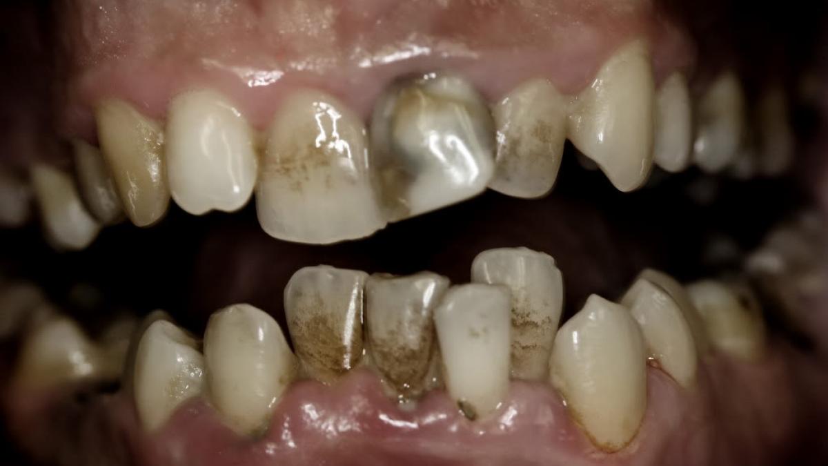 ce se intampla cu dantura noastra din cauza alimentatiei moderne