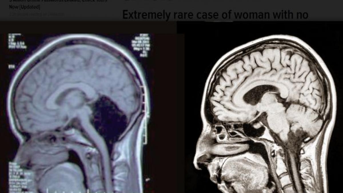 caz medical extrem de rar o femeie de 24 de ani nu are cerebel