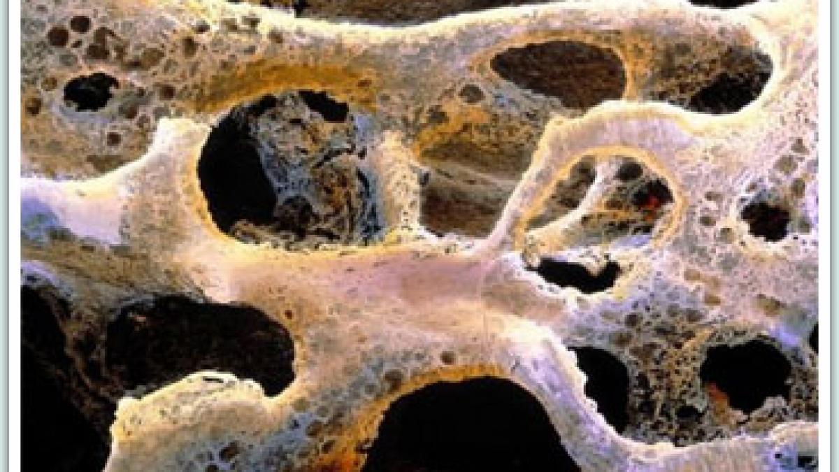 tratamente eficiente impotriva osteoporozei si ce sa mananci pentru a evita sau ameliora boala