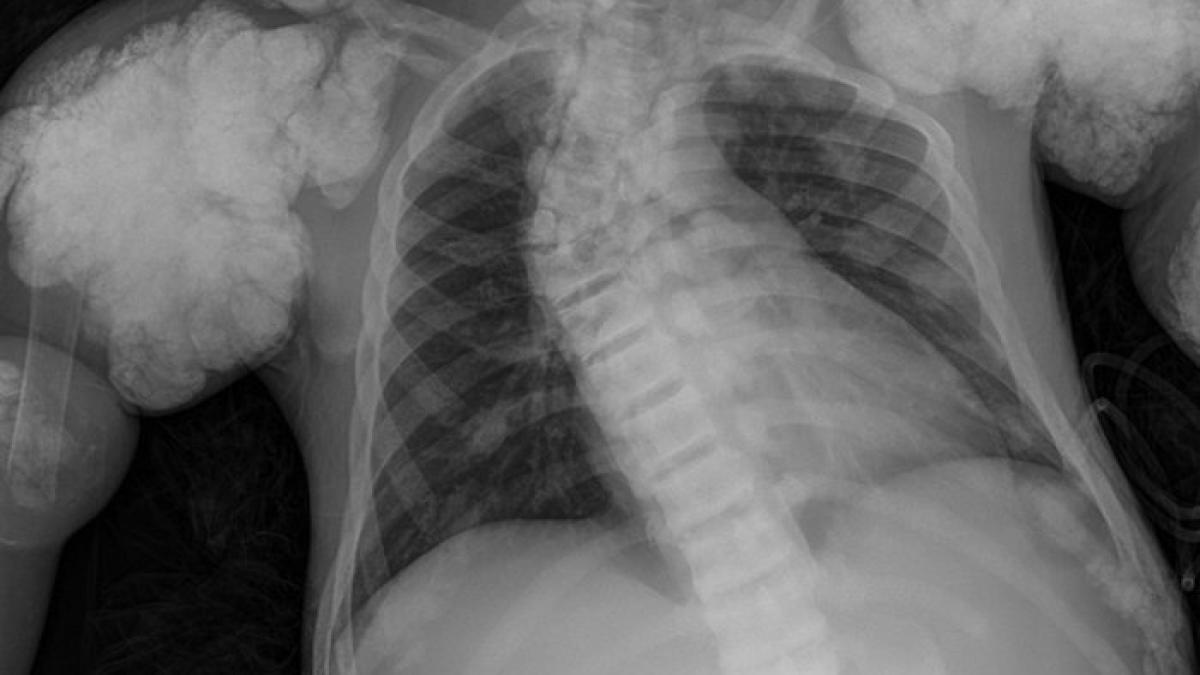 minunea corpului uman care i a lasat pe medici fara cuvinte i a crescut la loc o parte din coasta