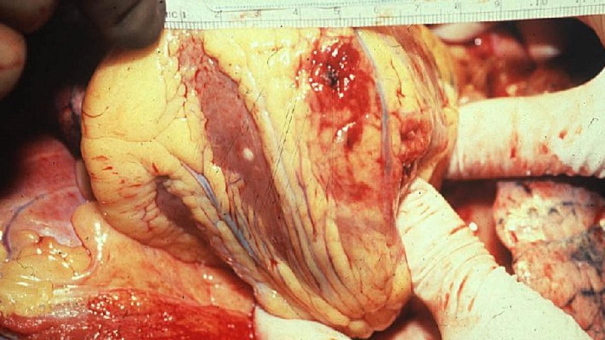 obezitatea fumatul si sedentarismul ne omoara un roman face infarct la fiecare 30 de minute