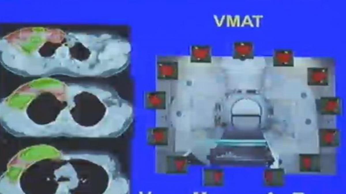 100 de minute sansa in lupta impotriva cancerului