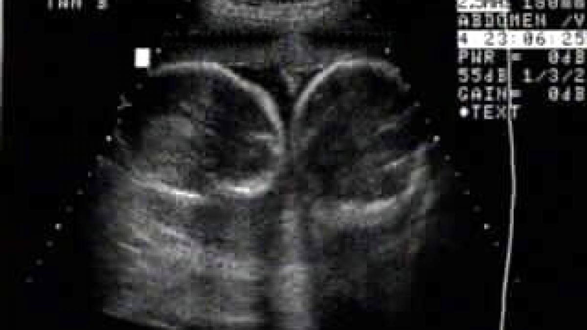 fericire maxima pentru casa regala ce au descoperit medicii la prima ecografie facuta lui kate