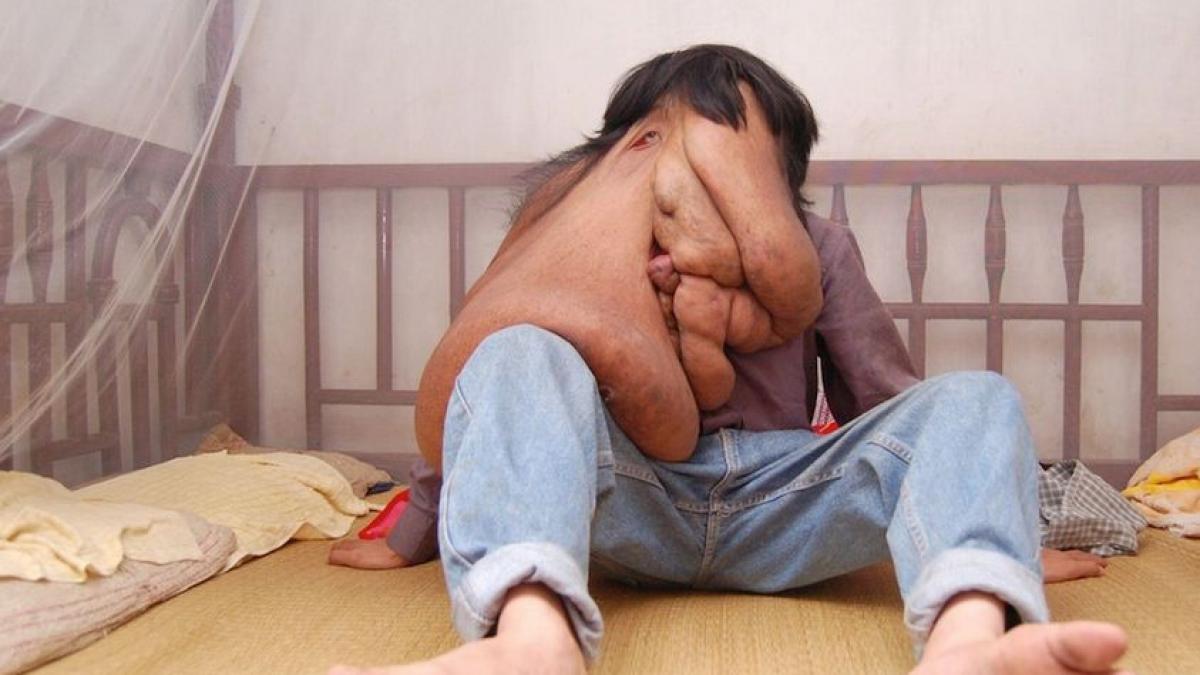 i se spune omul elefant tumora lui cantarea 25 de kilograme dar medicii au reusit un miracol