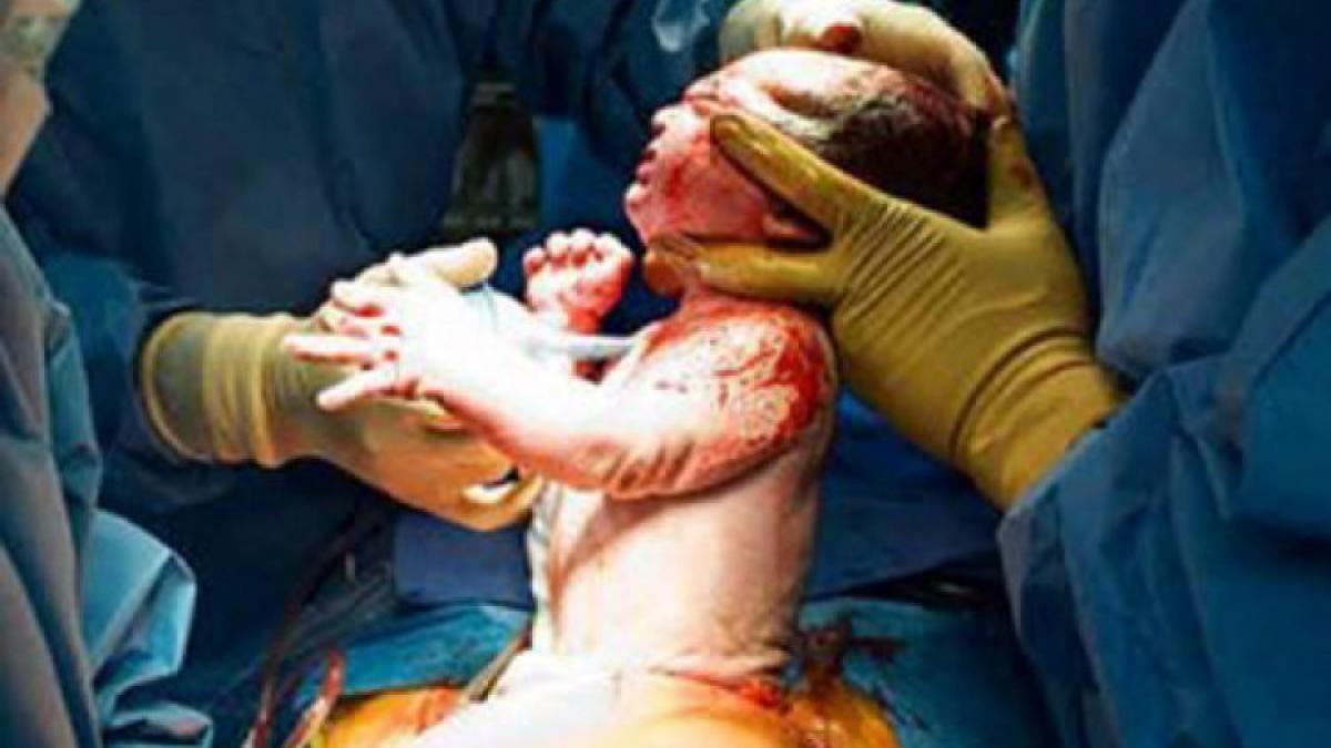 de ce copiii nascuti prin cezariana sunt mai predispusi la obezitate