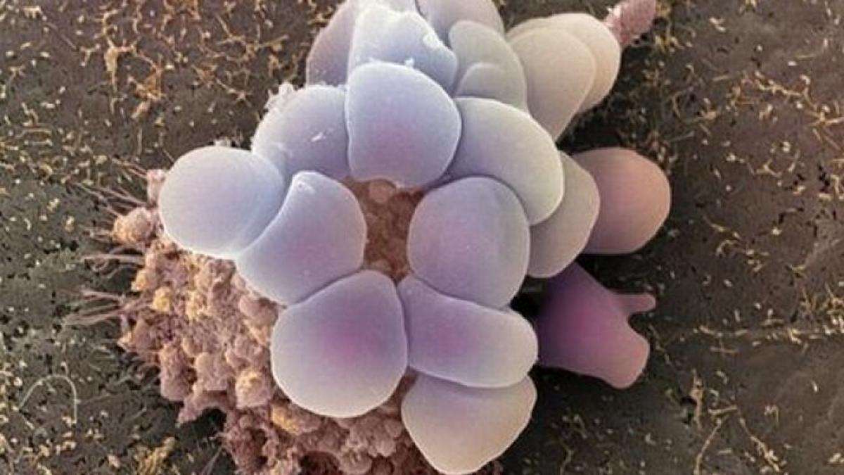 test care ajuta la identificarea tratamentului corect pentru cancer ovarian dezvoltat de medici