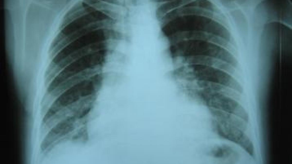 oms in alerta 1 5 milioane de oameni ucisi de aceasta boala nu mai raspunde la tratament