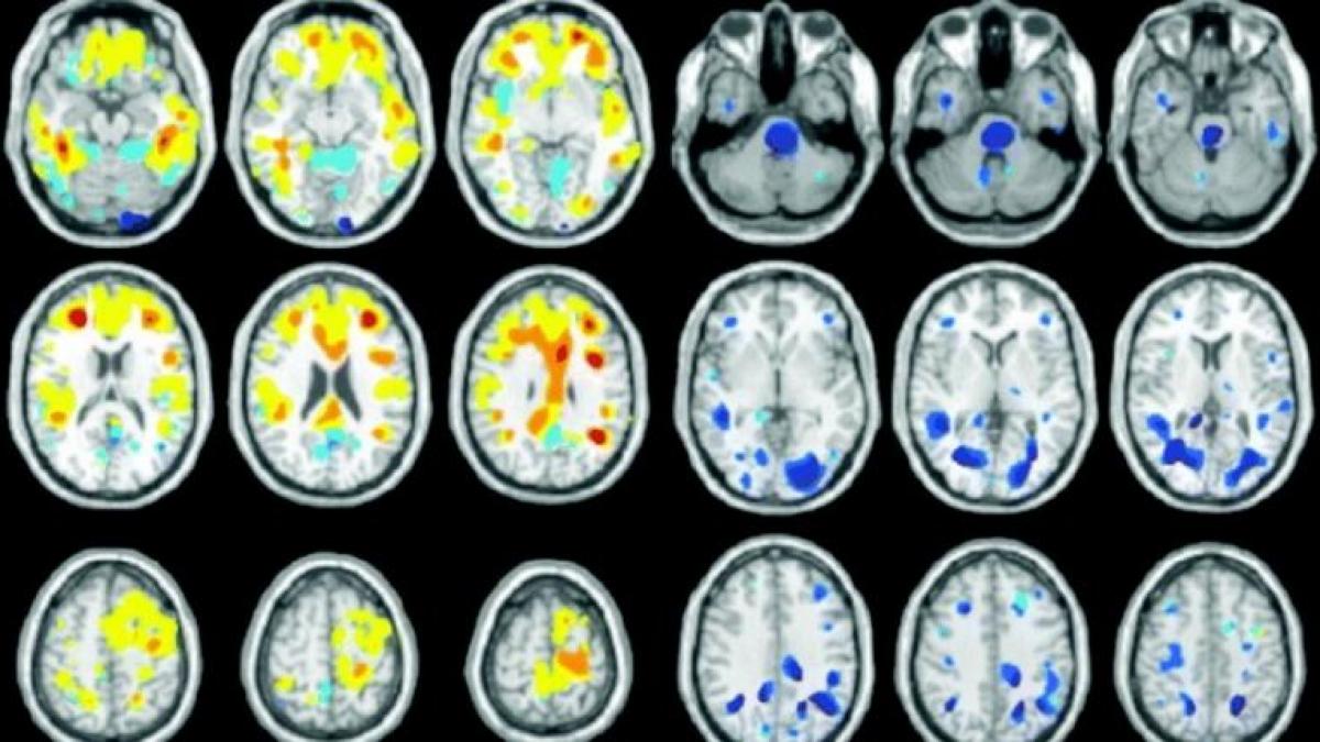 boala de care poti suferi fara sa ai habar iata simptomele