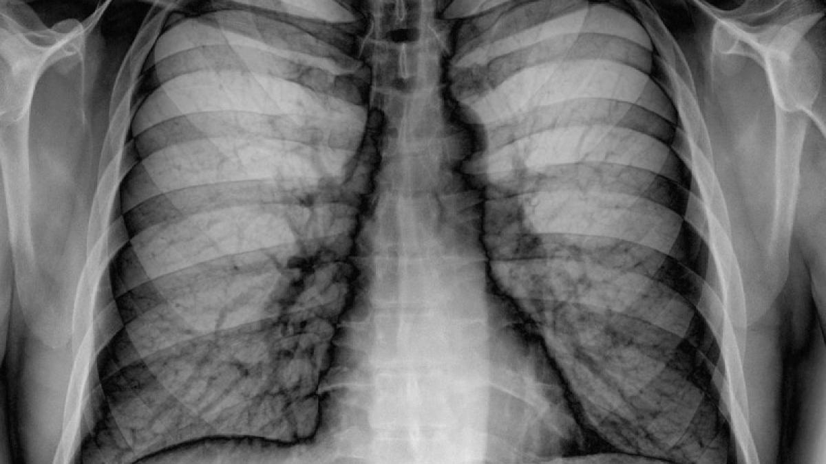 afli cand e prea tarziu cea mai perfida forma de cancer nu te doare nimic