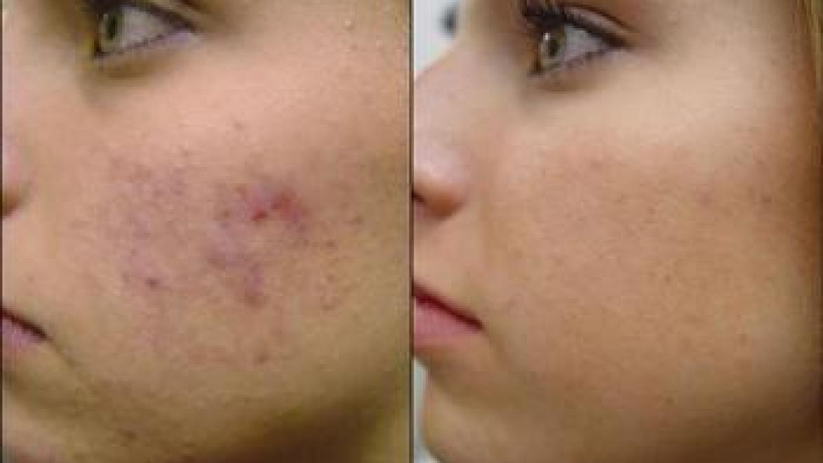 cele mai bune metode pentru a avea grija de tenul cu probleme