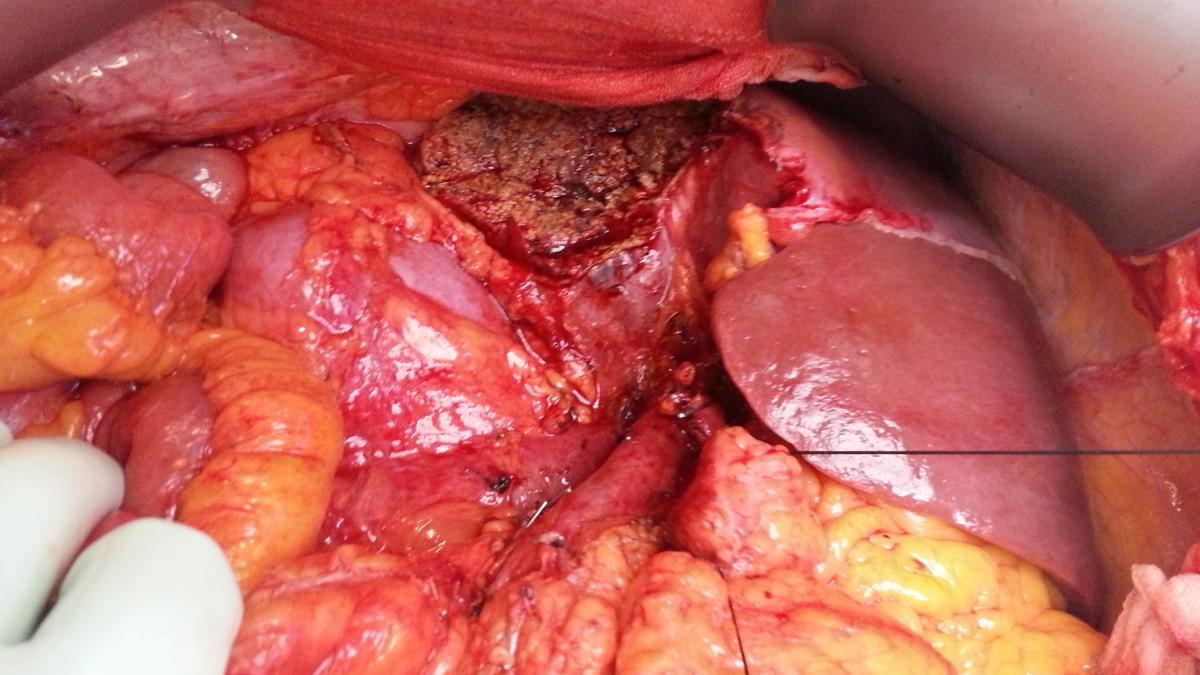 datele oficiale care ar trebui sa ne ingrijoreze cati romani sufera de cancer gastric