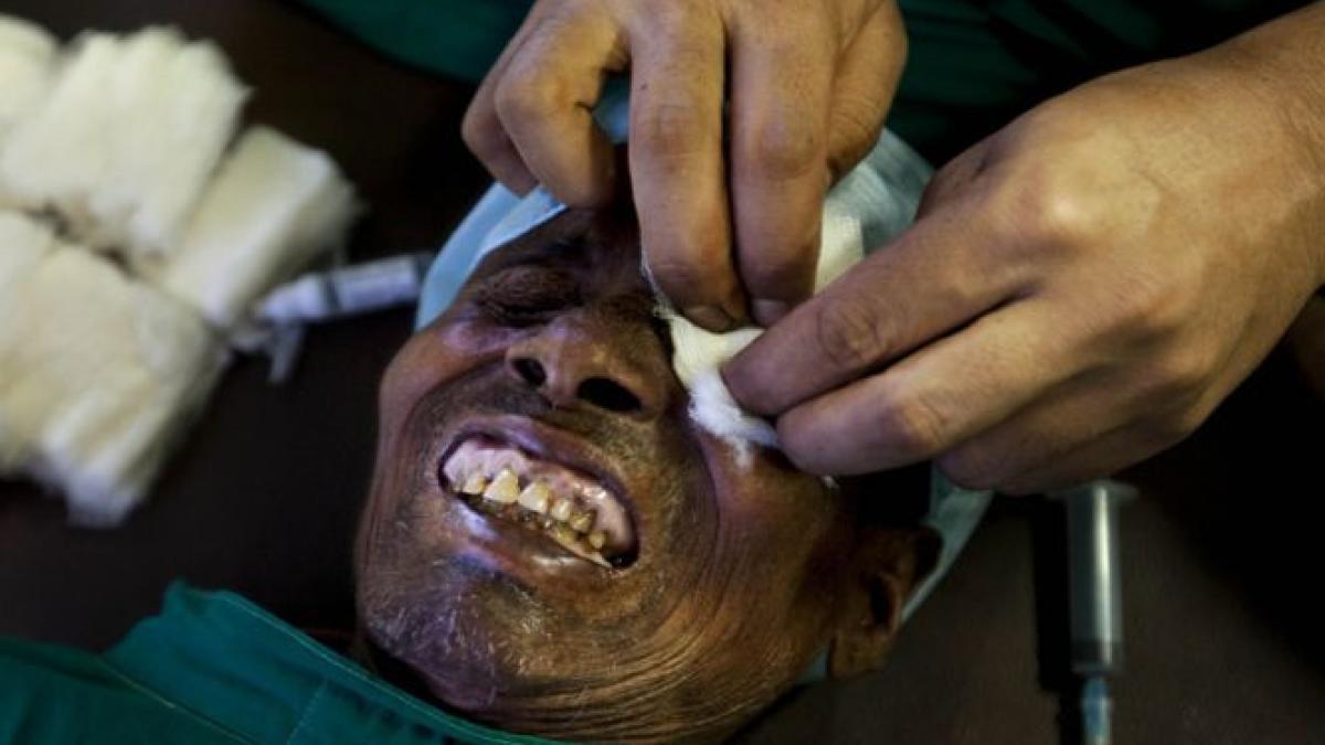 15 indieni au ramas orbi dupa ce au fost operati gratuit de cataracta