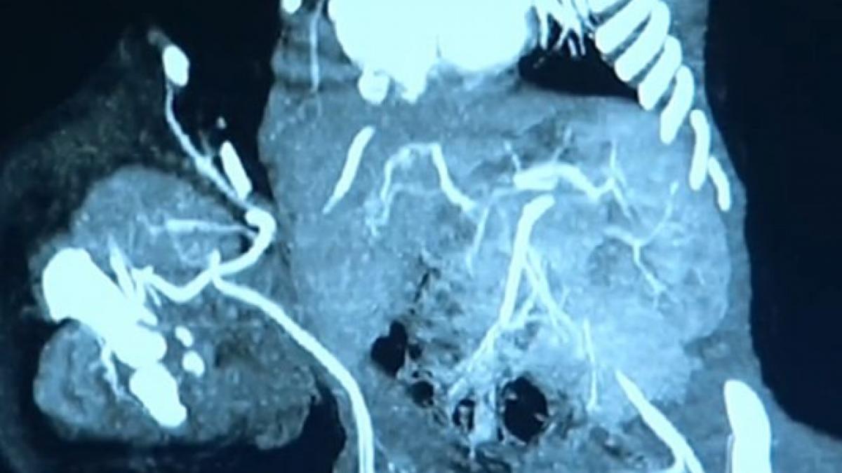 operatie rara la spitalul marie curie din capitala doctorii au separat o pereche de gemeni siamezi