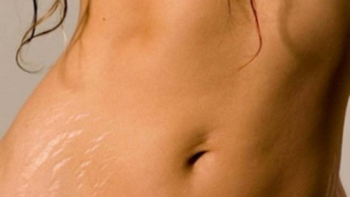 numai de bine cum eliminam vergeturile