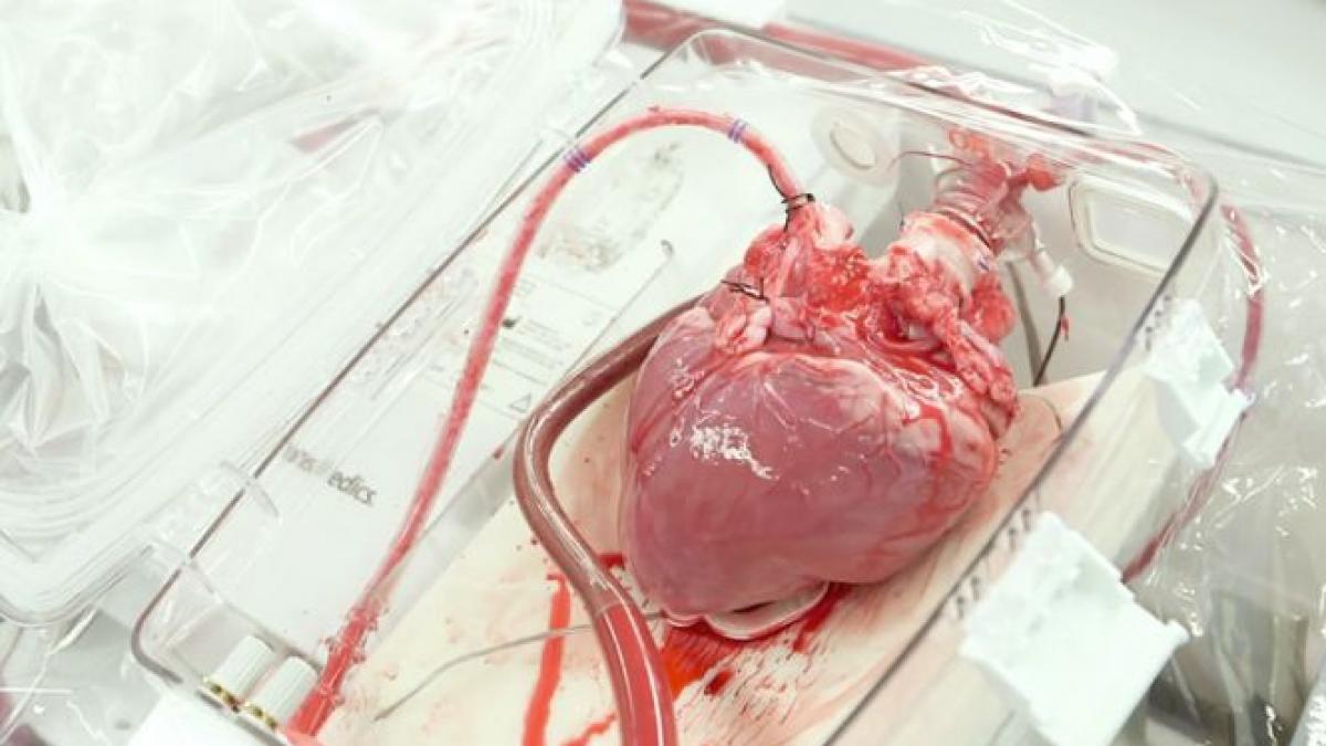 un barbat de 47 de ani din neamt a beneficiat de primul transplant de inima din romania din acest an
