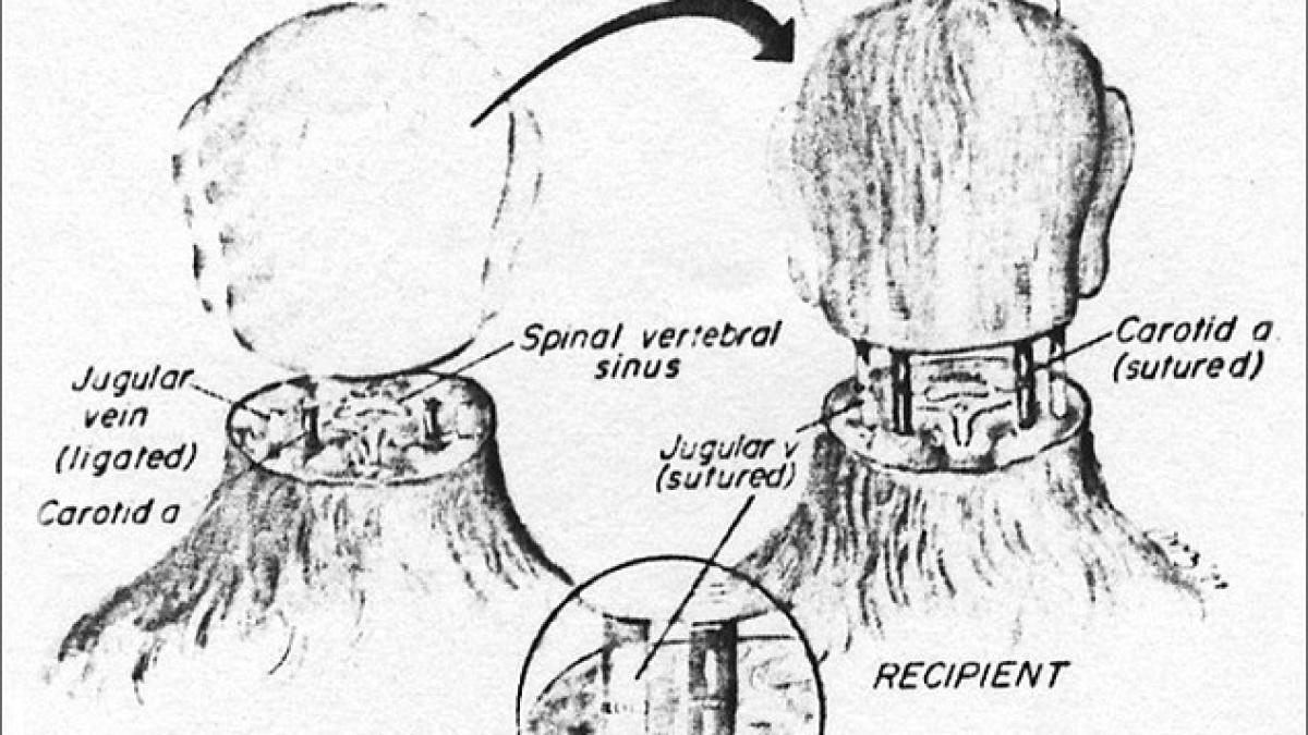 inovatie sau nebunie curata el este pacientul care se ofera voluntar primului transplant de cap