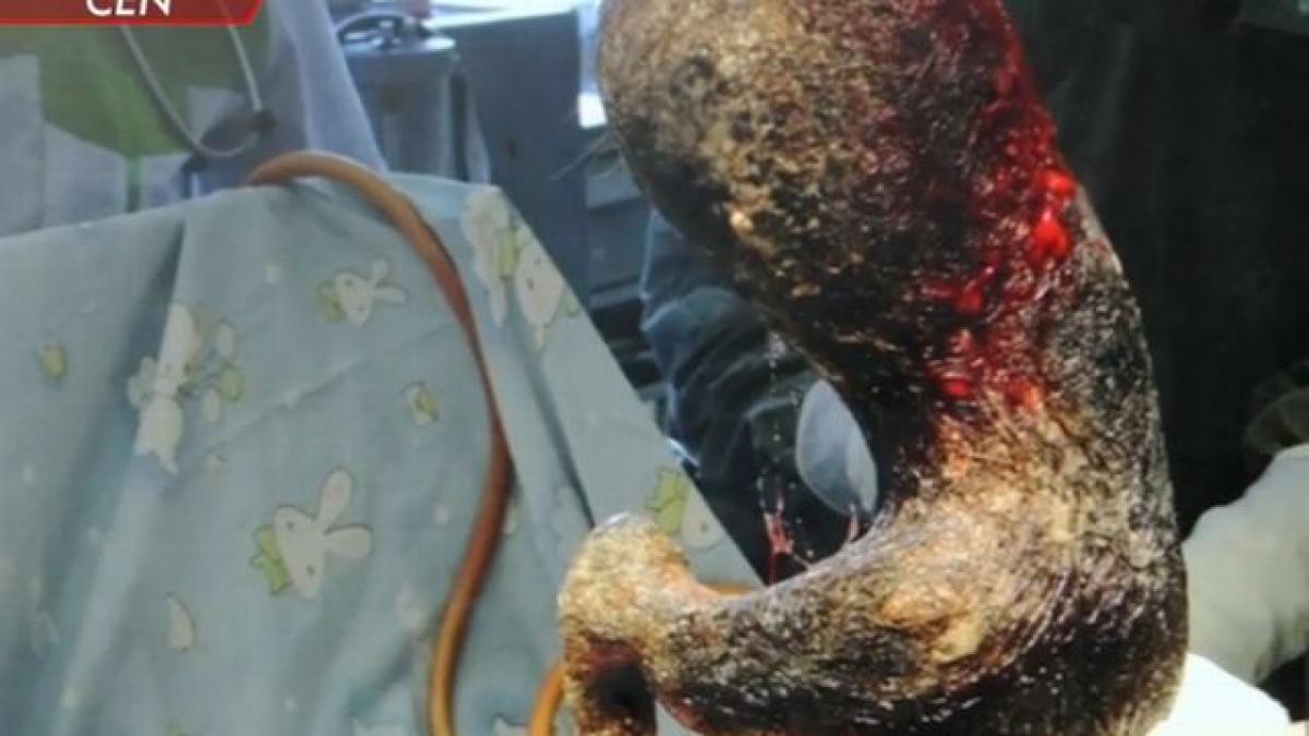 video o minge de par de 4 kilograme a fost scoasa din stomacul unei adolescente