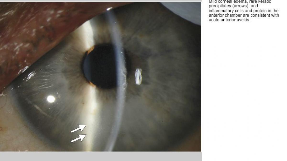 un medic american vindecat de ebola descopera cu stupoare ca virusul traieste in ochiul sau