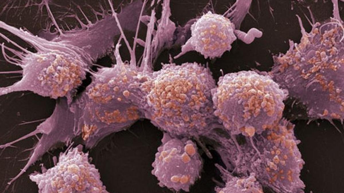 terapia care poate prelungi viata persoanelor bolnave de cancer de piele