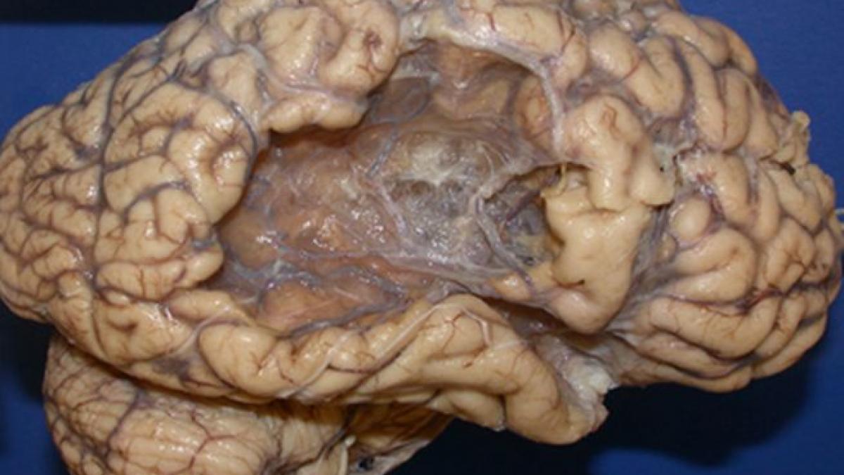 cum arata creierul uman dupa un atac cerebral