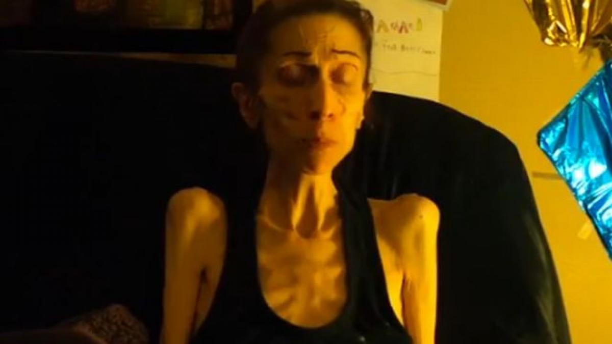 ce s a intamplat cu femeia careia i s a spus ca e prea slaba sa fie tratata si cum arata inainte de