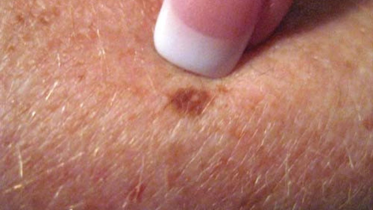 care sunt factorii ce pot determina aparitia cancerului cutanat